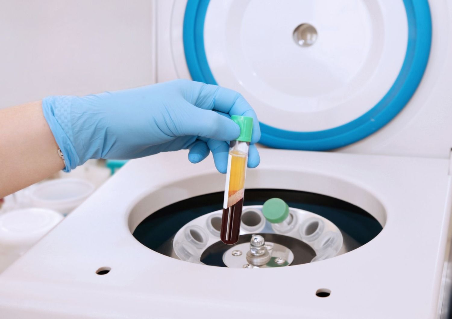 PRP Injections: A Natural Treatment for Hair Loss