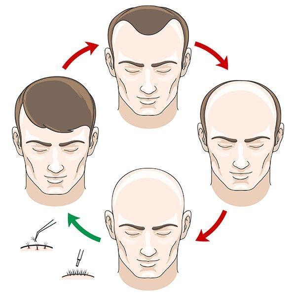 combien_de_greffons_faut_il_pour_une_greffe_de_cheveux_reussie_