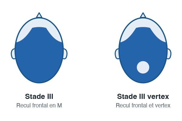 echelle_de_norwood_a_quel_stade_de_calvitie_envisager_une_greffe_de_cheveux