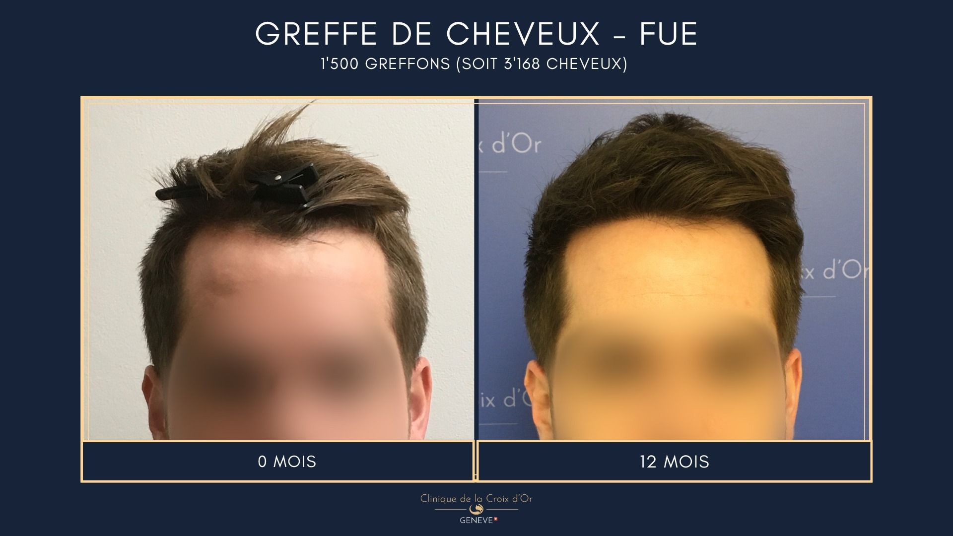 Hair Transplant - FUE