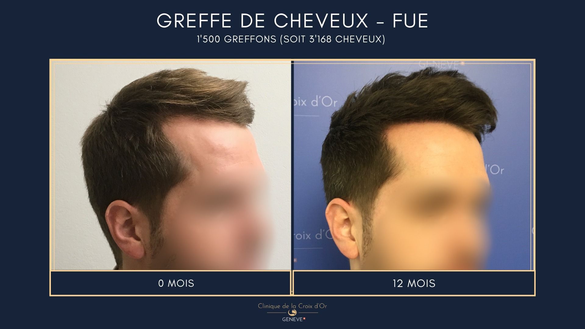 Hair Transplant - FUE