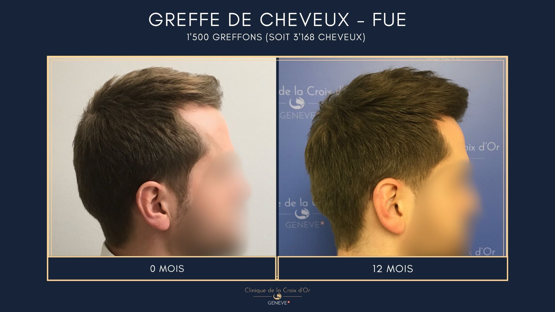 Hair Transplant - FUE