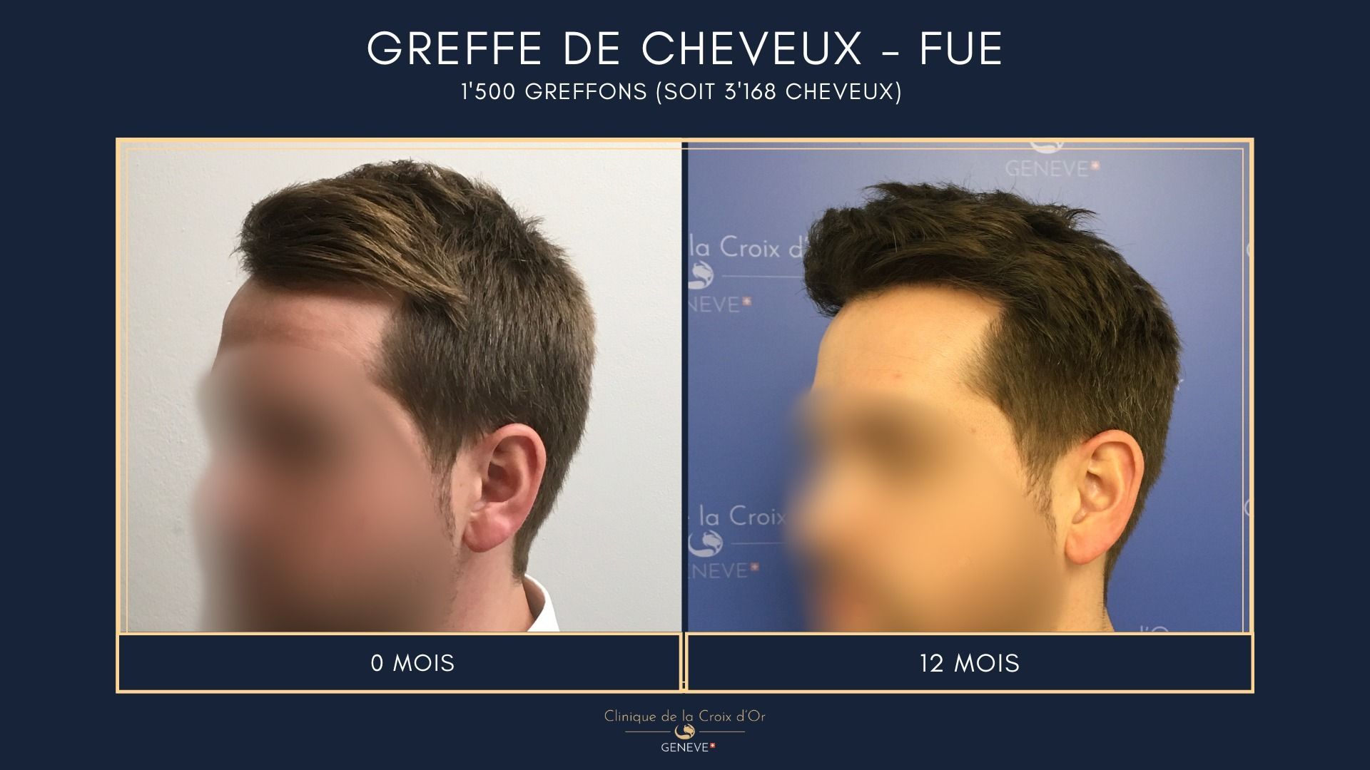 Hair Transplant - FUE