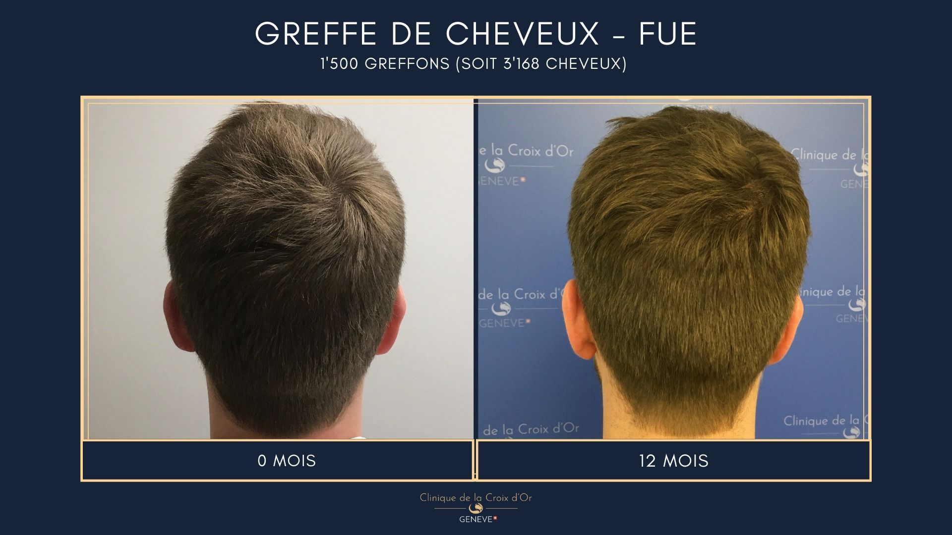 Hair Transplant - FUE