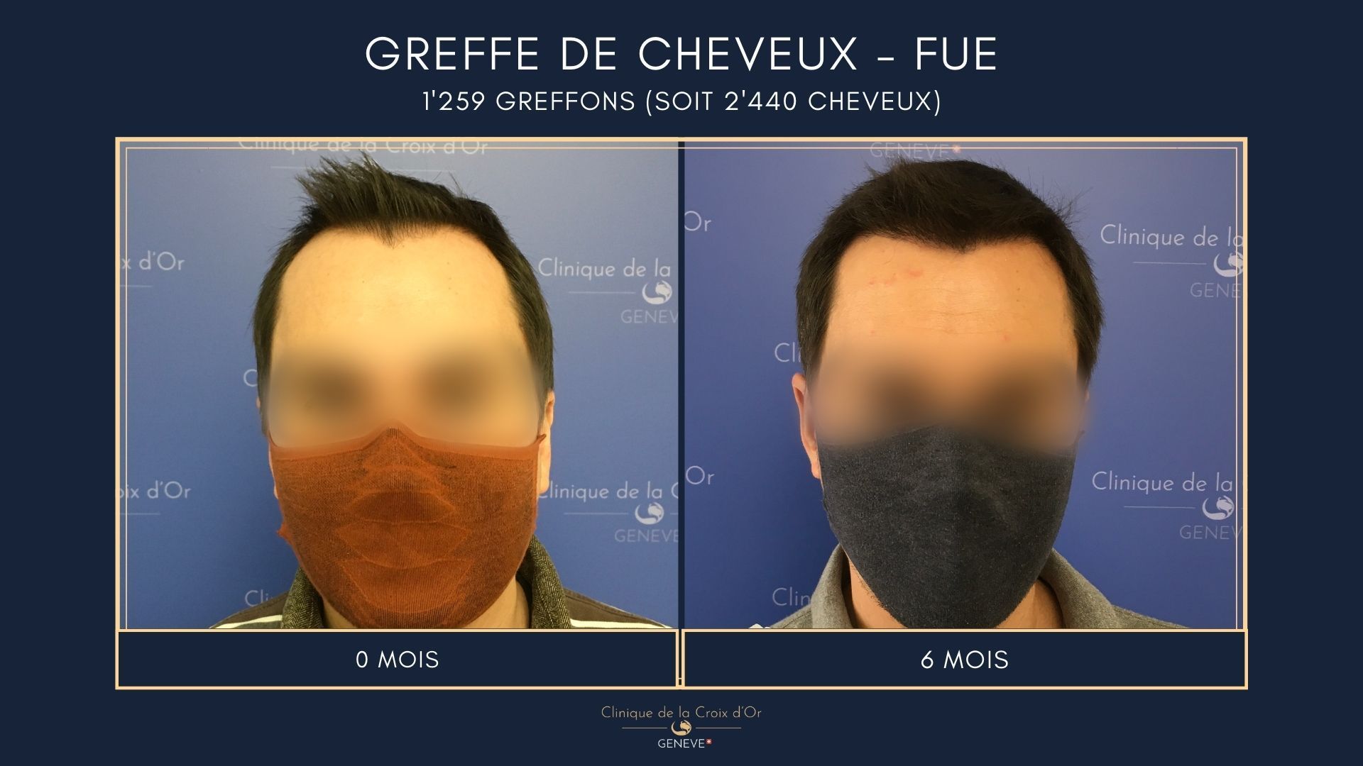 Hair Transplant - FUE