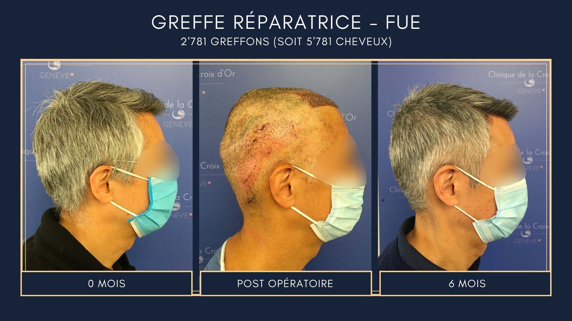 Reparative or corrective hair transplant