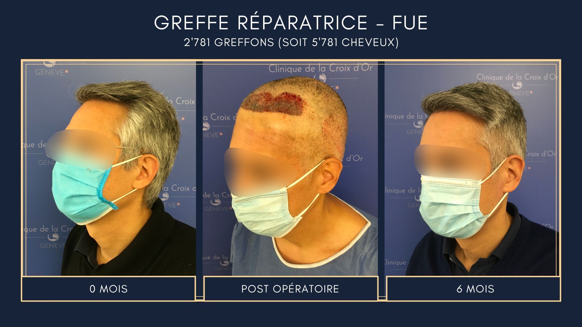 Reparative or corrective hair transplant