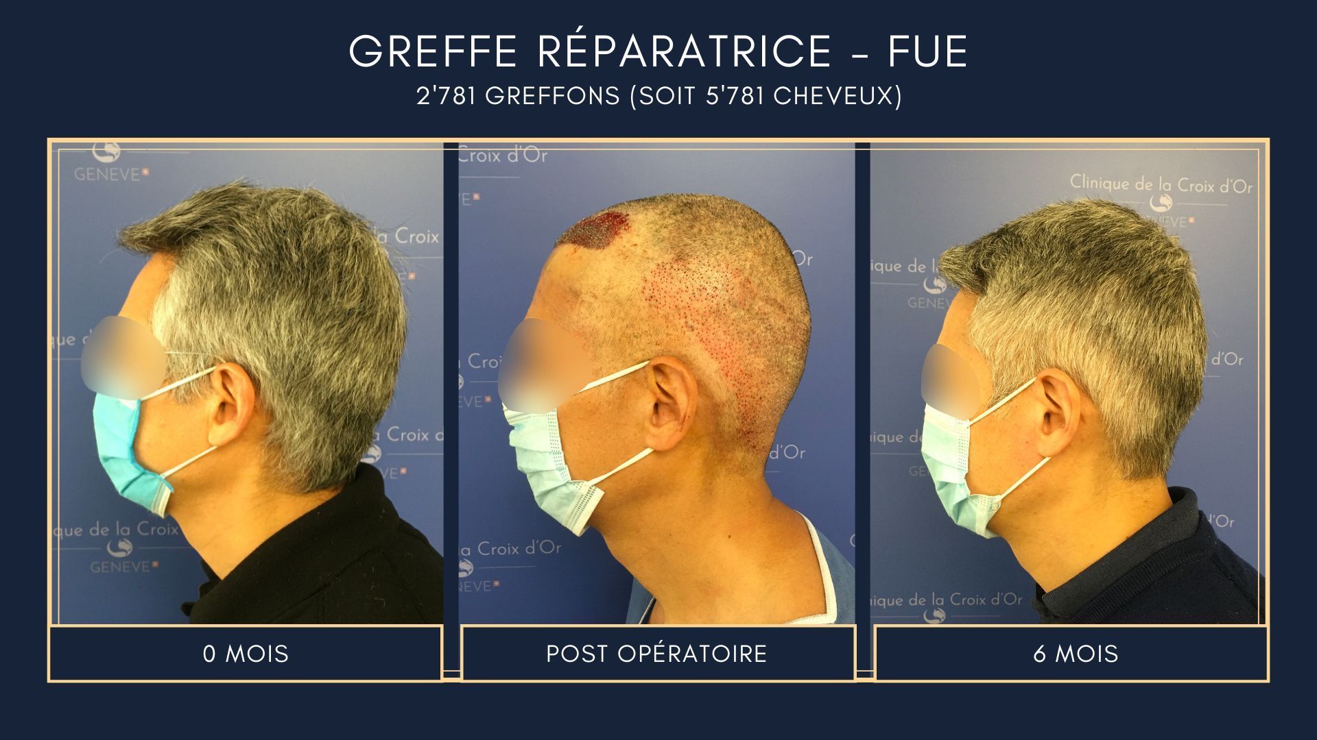 Reparative or corrective hair transplant