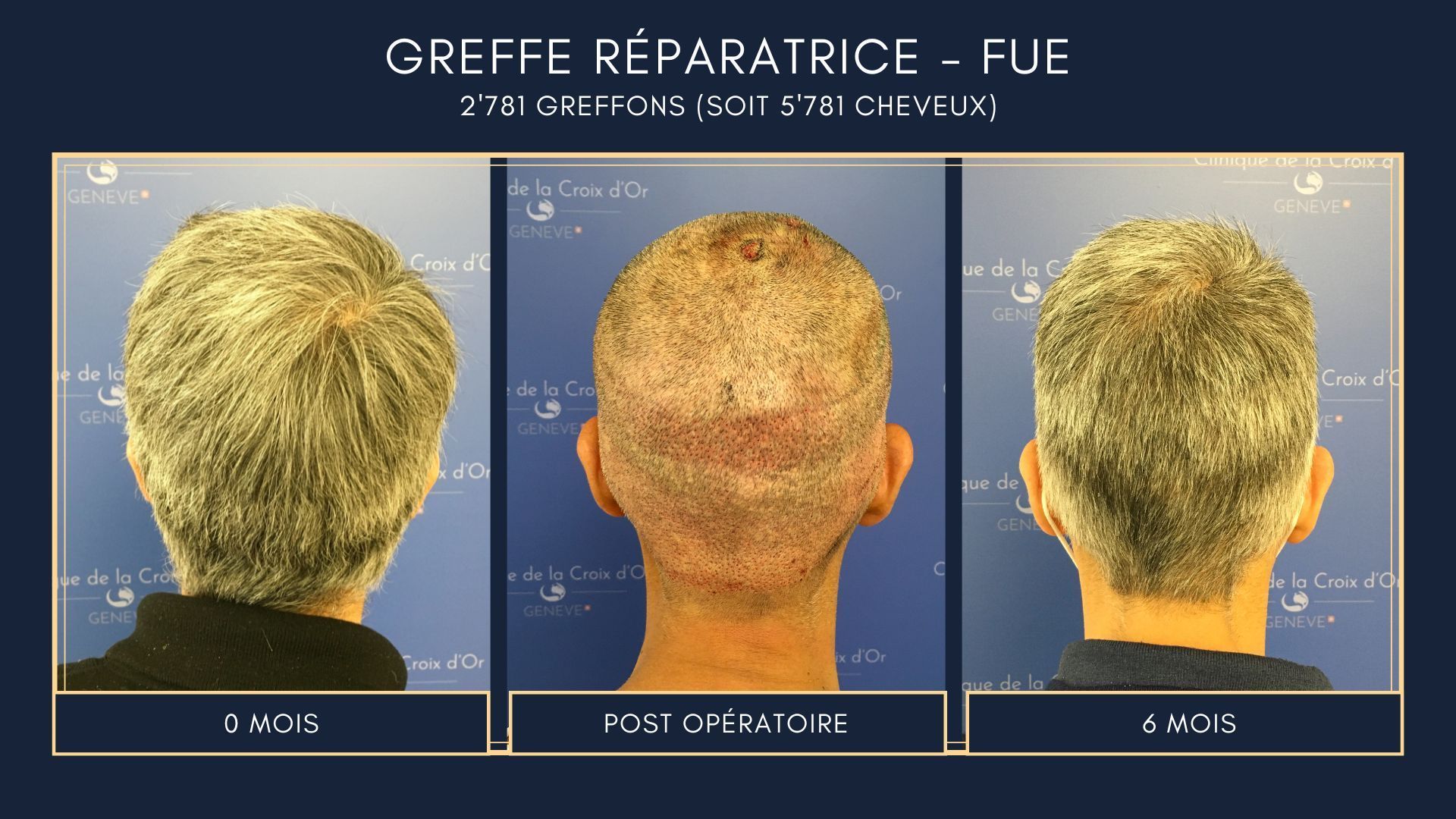 Reparative or corrective hair transplant