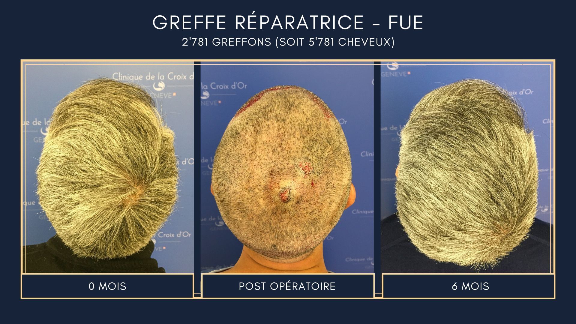 Reparative or corrective hair transplant