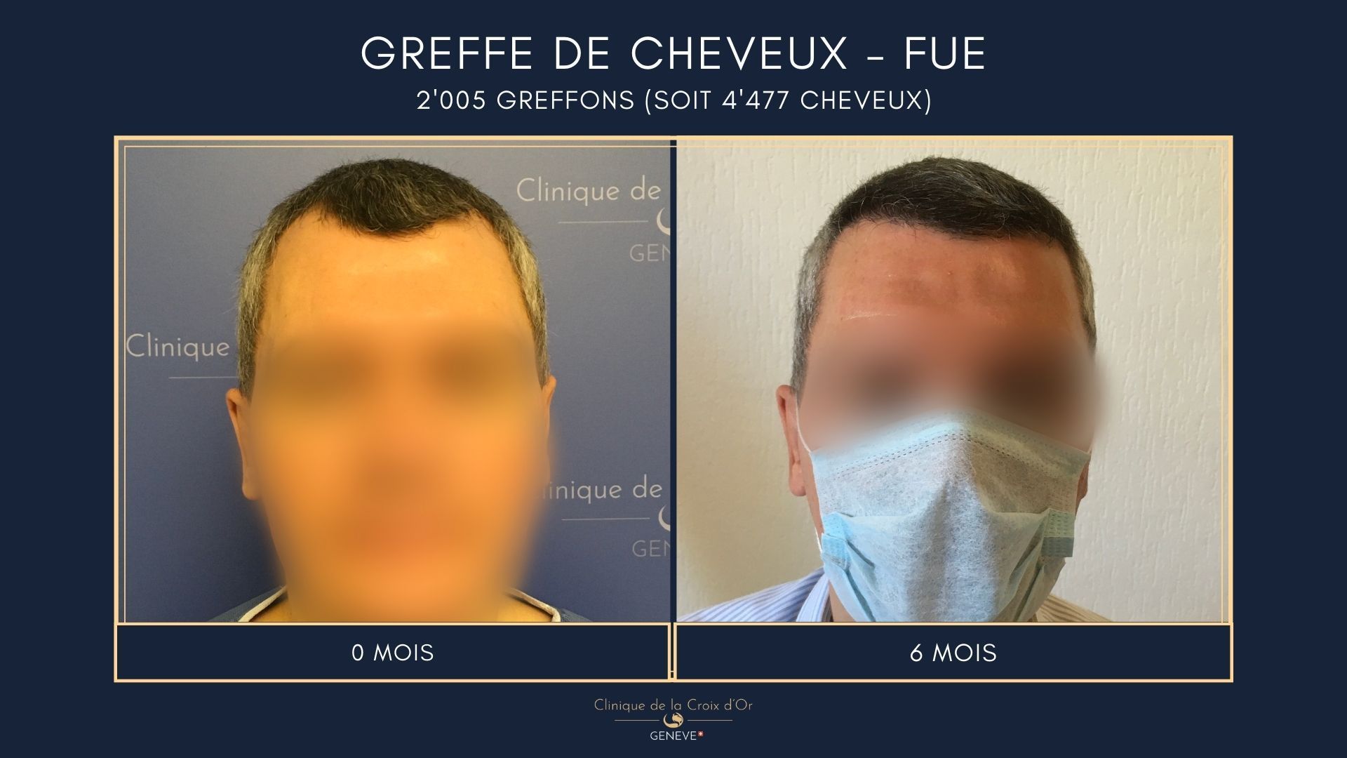Hair Transplant - FUE
