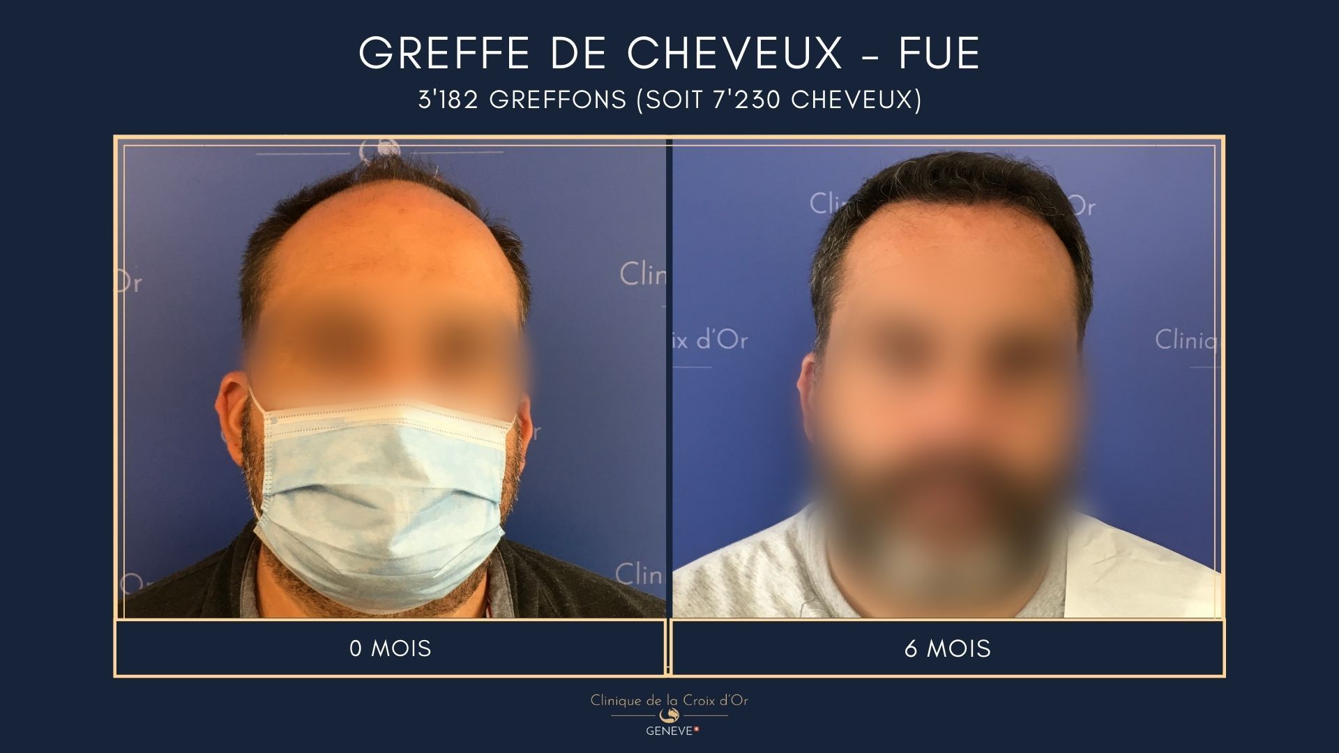 Hair Transplant - FUE
