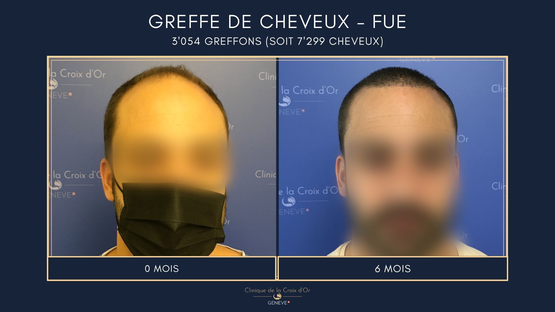 Hair Transplant - FUE