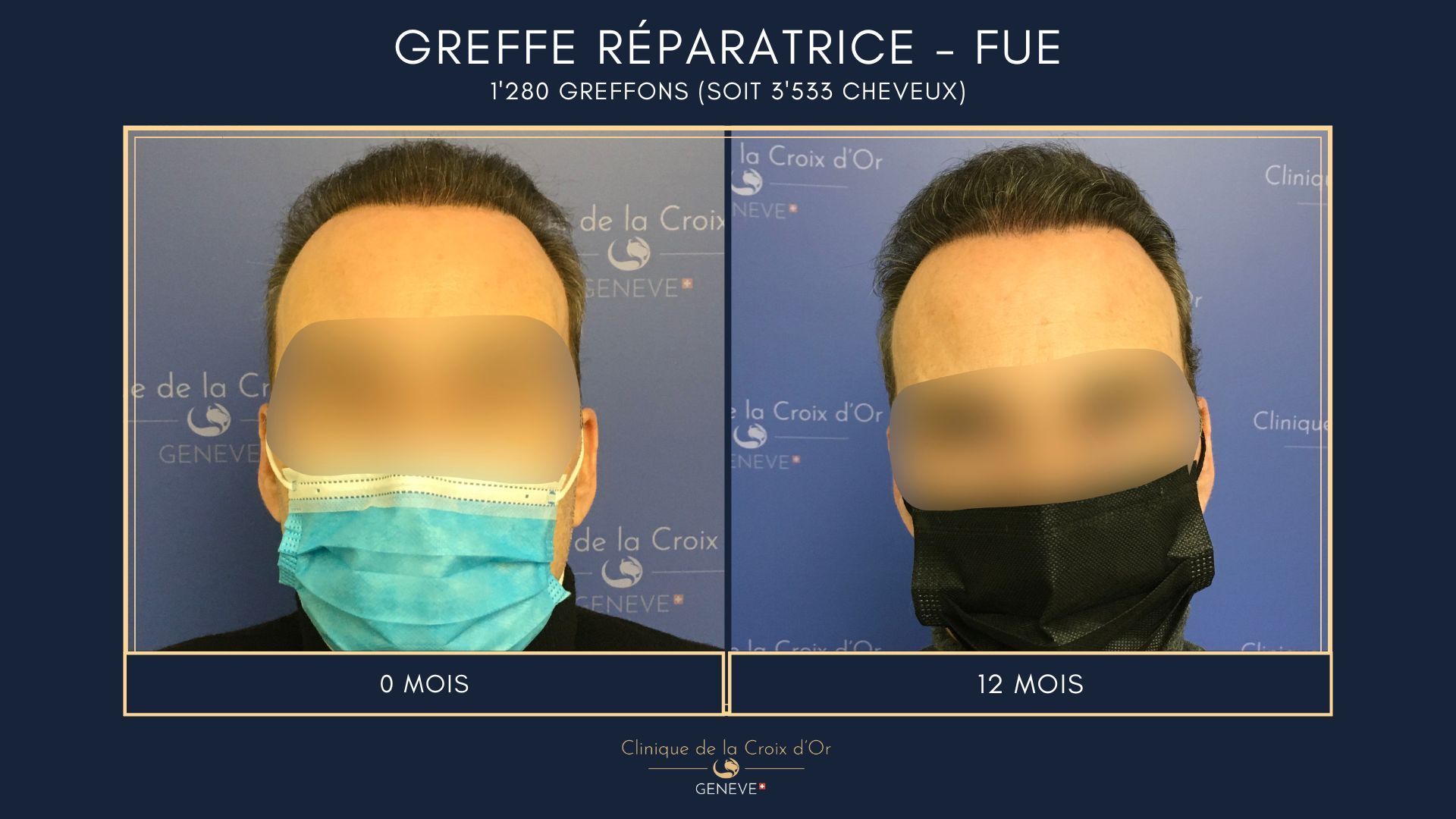 Reparative or corrective hair transplant