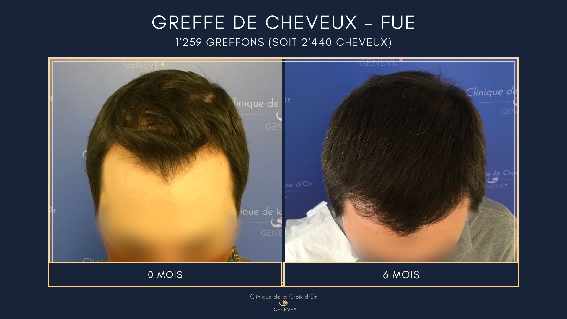 Hair Transplant - FUE
