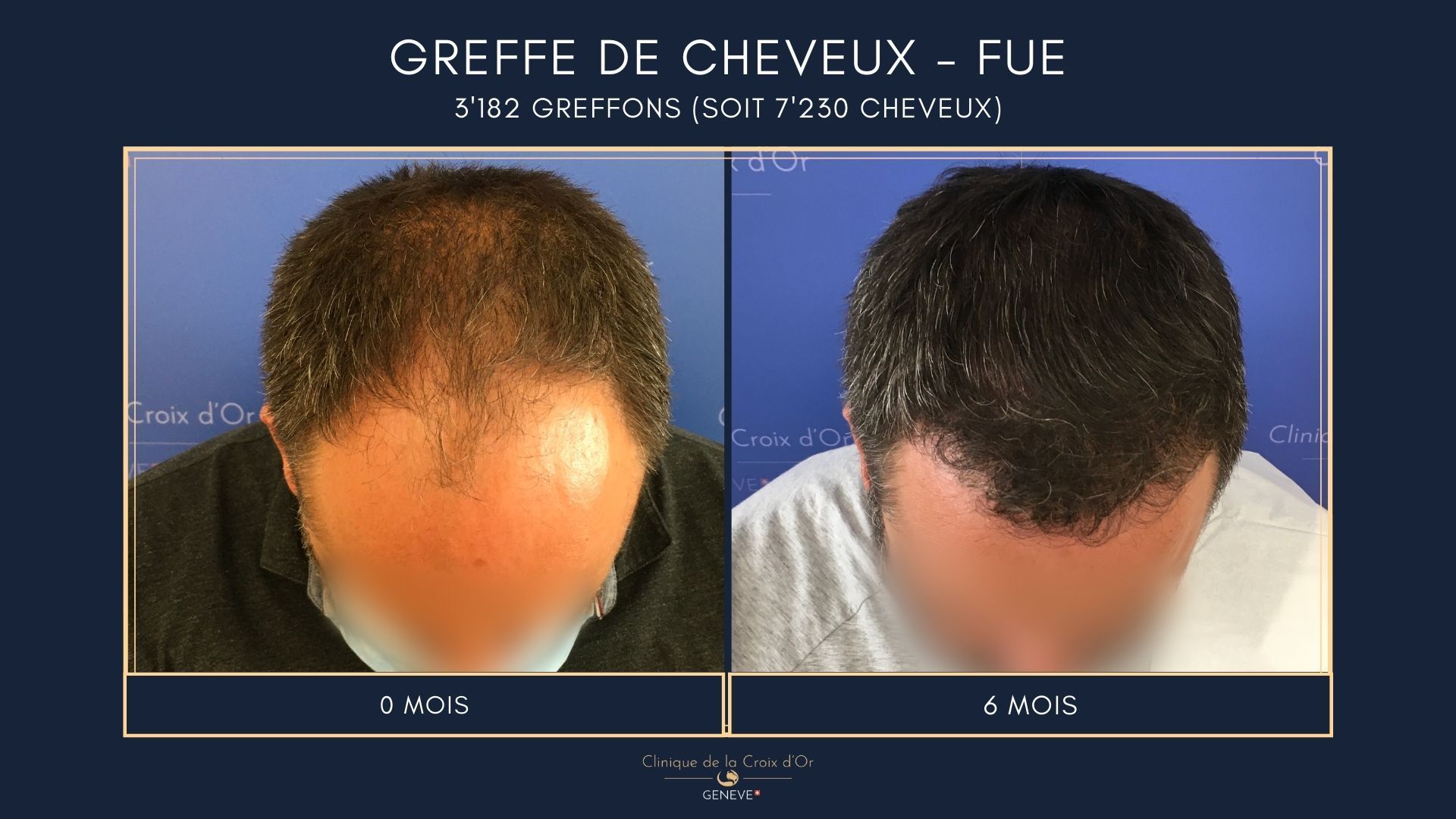 Hair Transplant - FUE