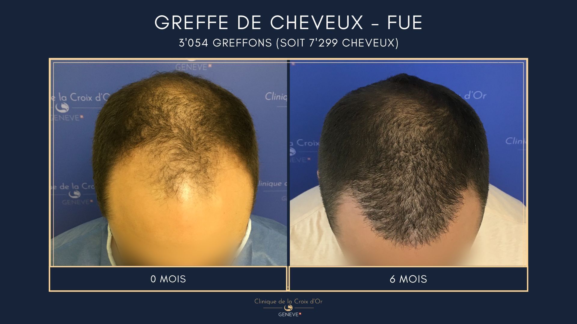 Hair Transplant - FUE