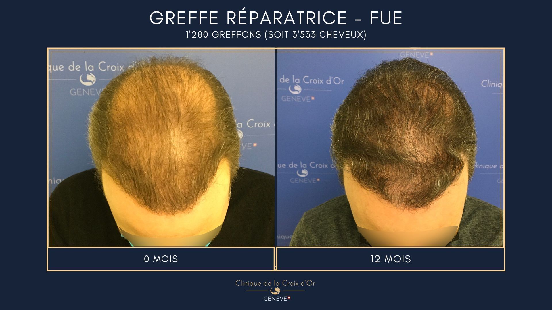 Reparative or corrective hair transplant