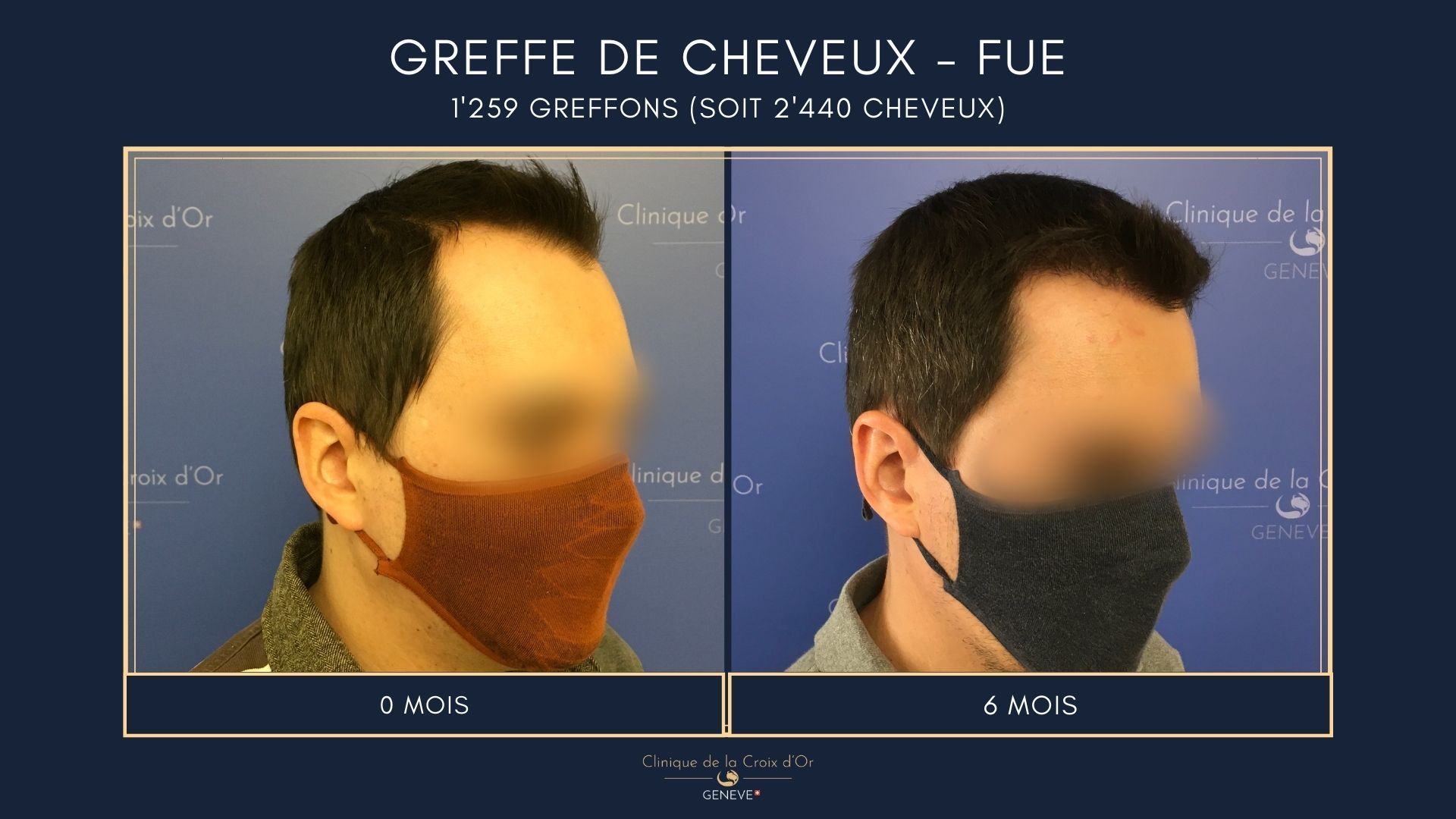 Hair Transplant - FUE