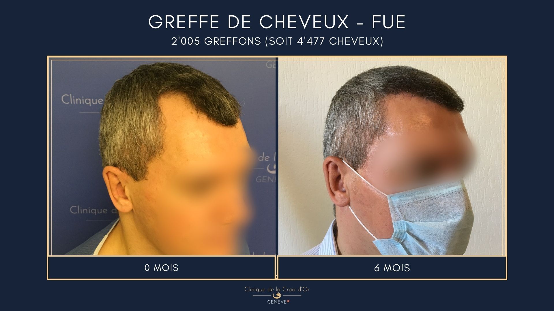 Hair Transplant - FUE