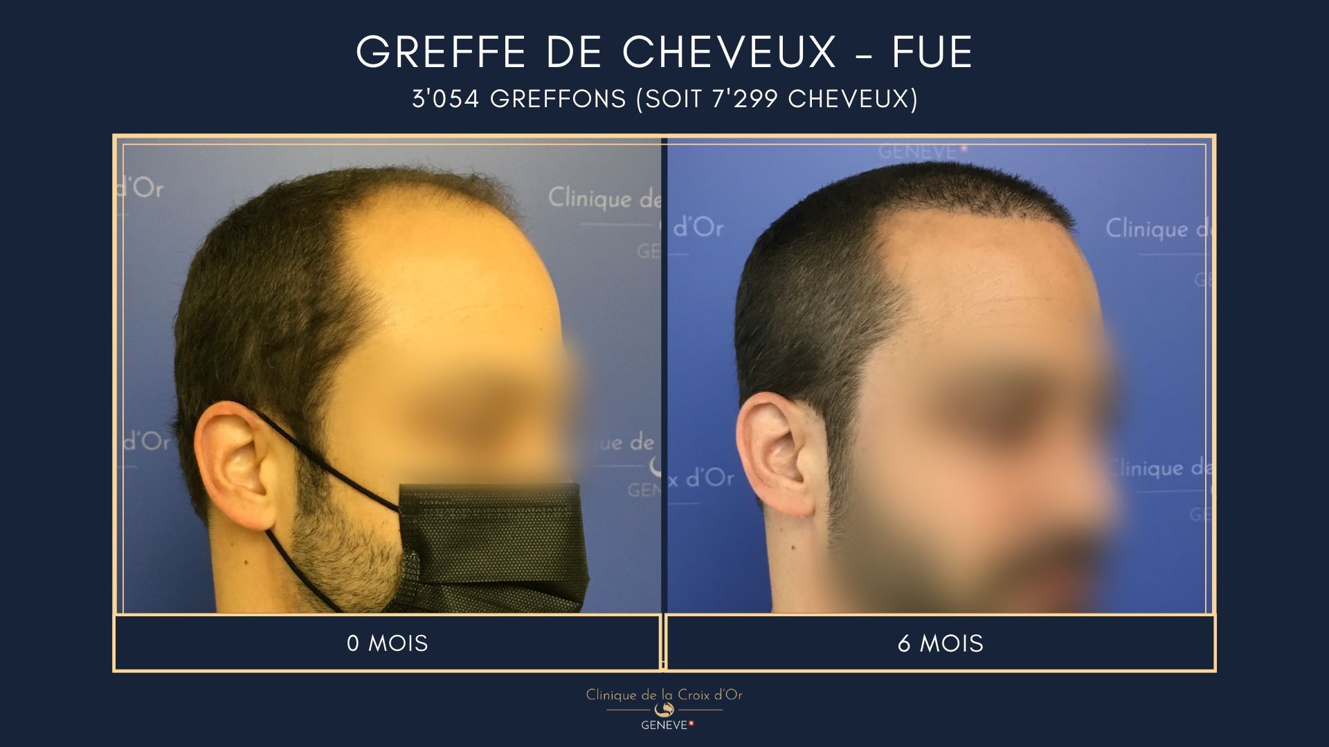 Hair Transplant - FUE