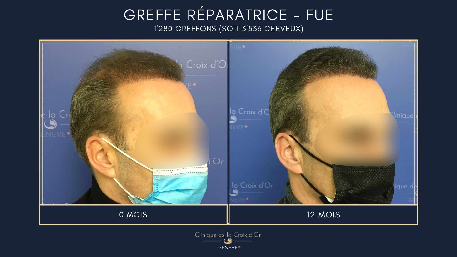 Reparative or corrective hair transplant