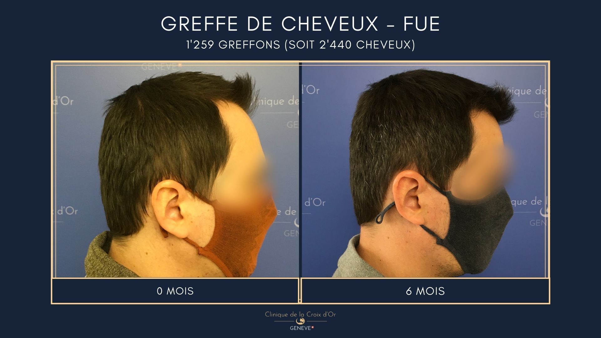 Hair Transplant - FUE
