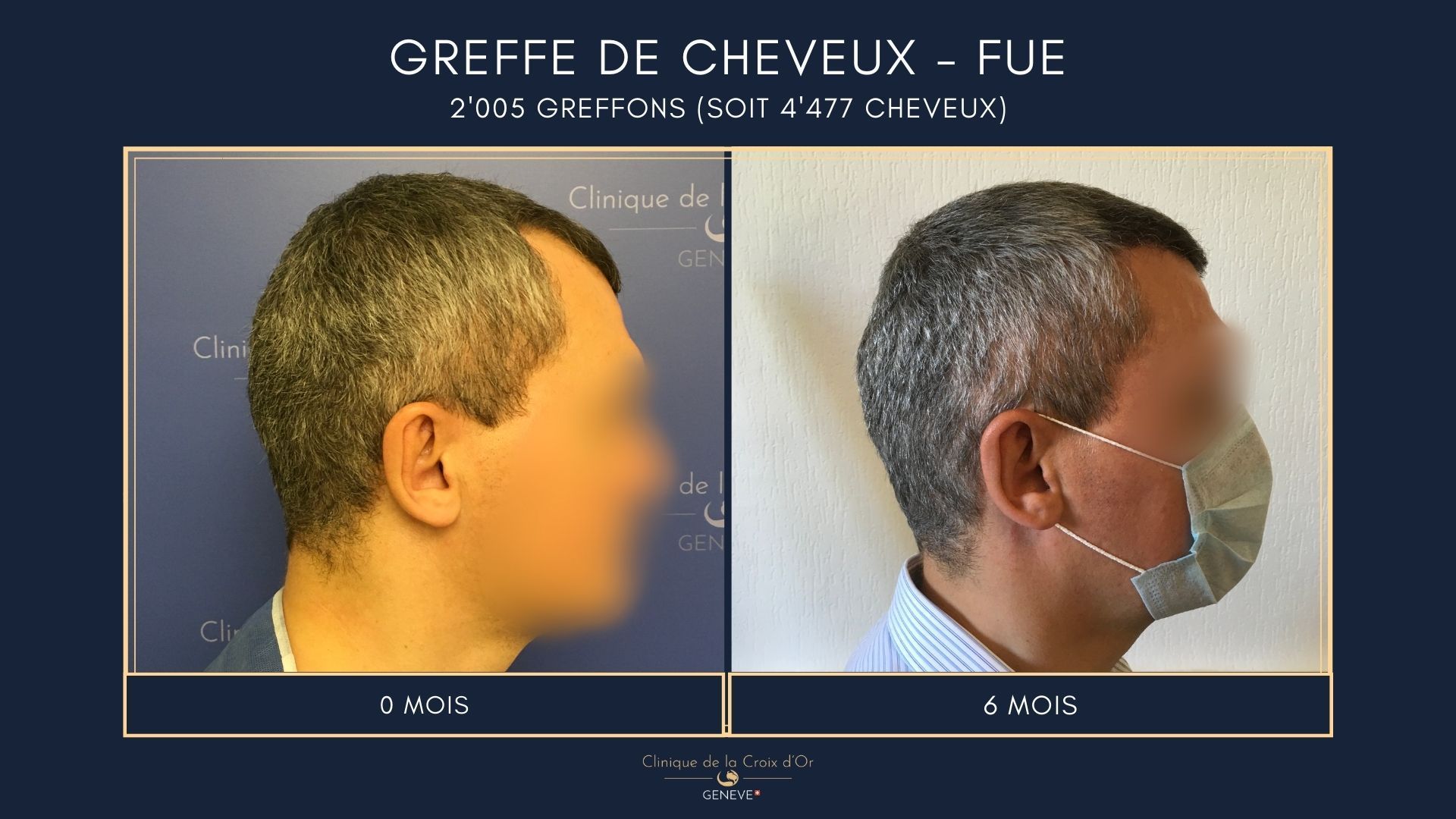 Hair Transplant - FUE