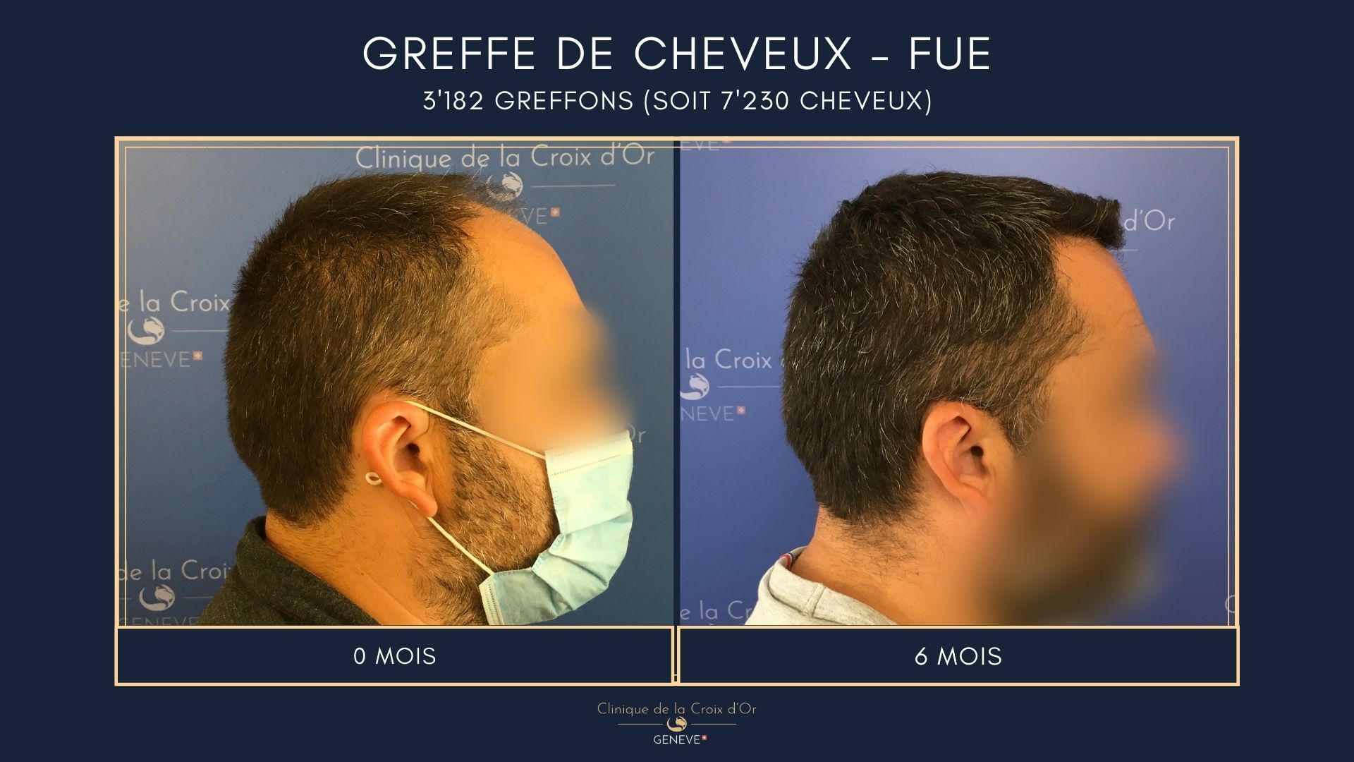 Hair Transplant - FUE