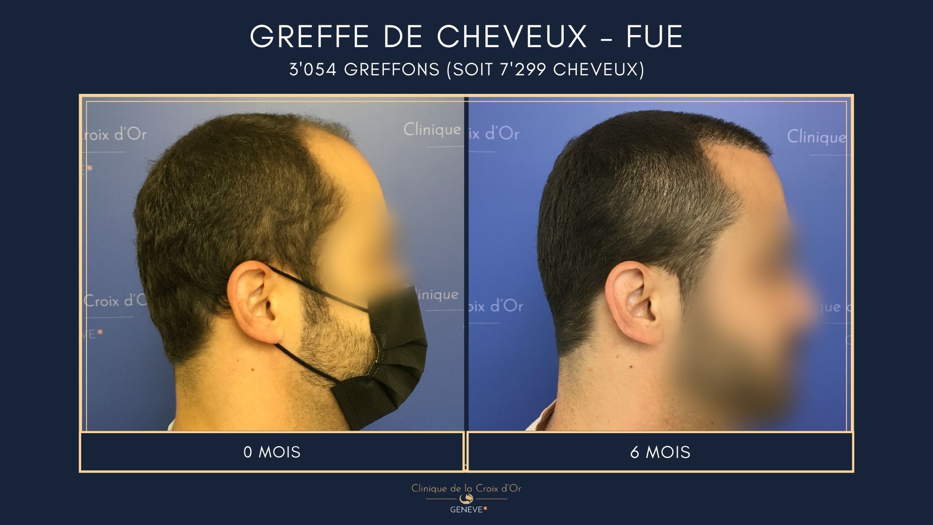 Hair Transplant - FUE