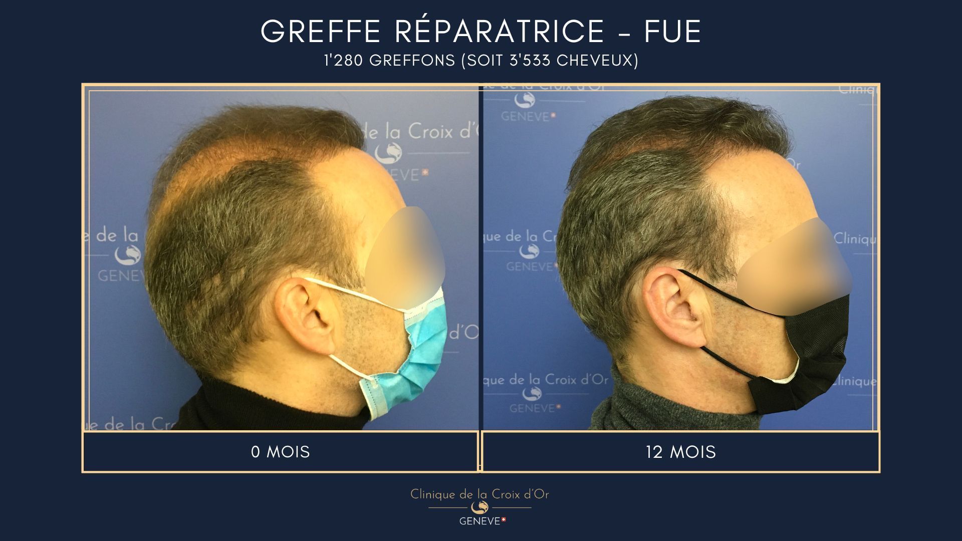 Reparative or corrective hair transplant
