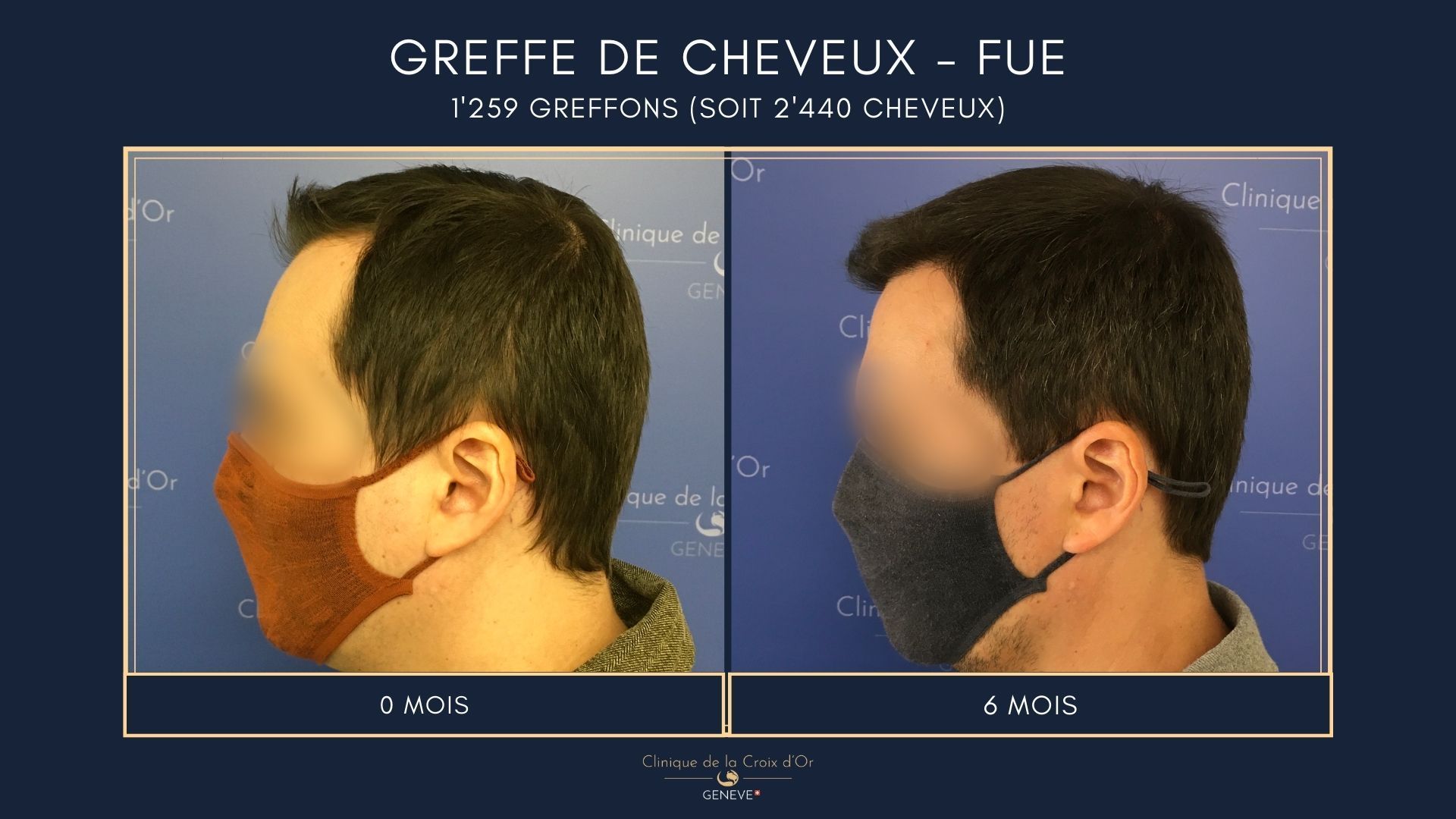 Hair Transplant - FUE