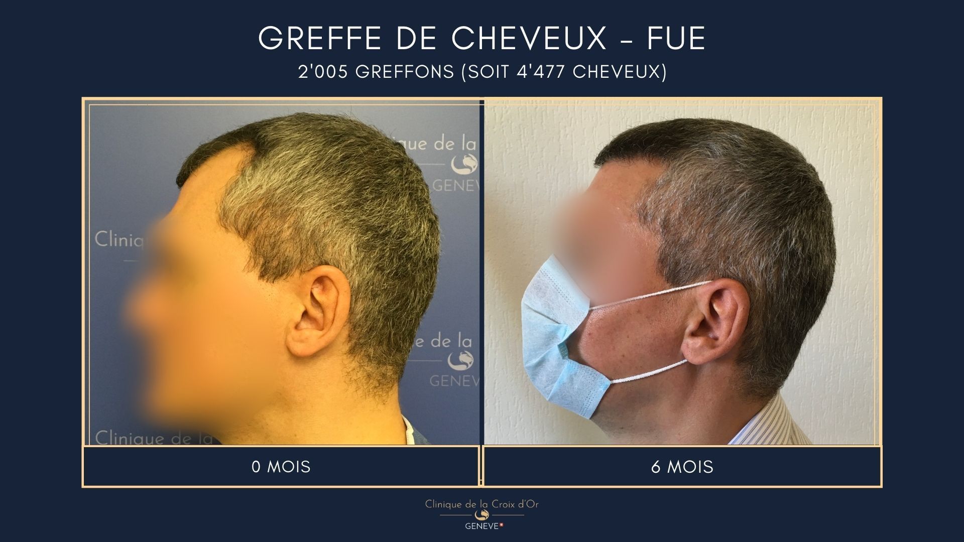 Hair Transplant - FUE