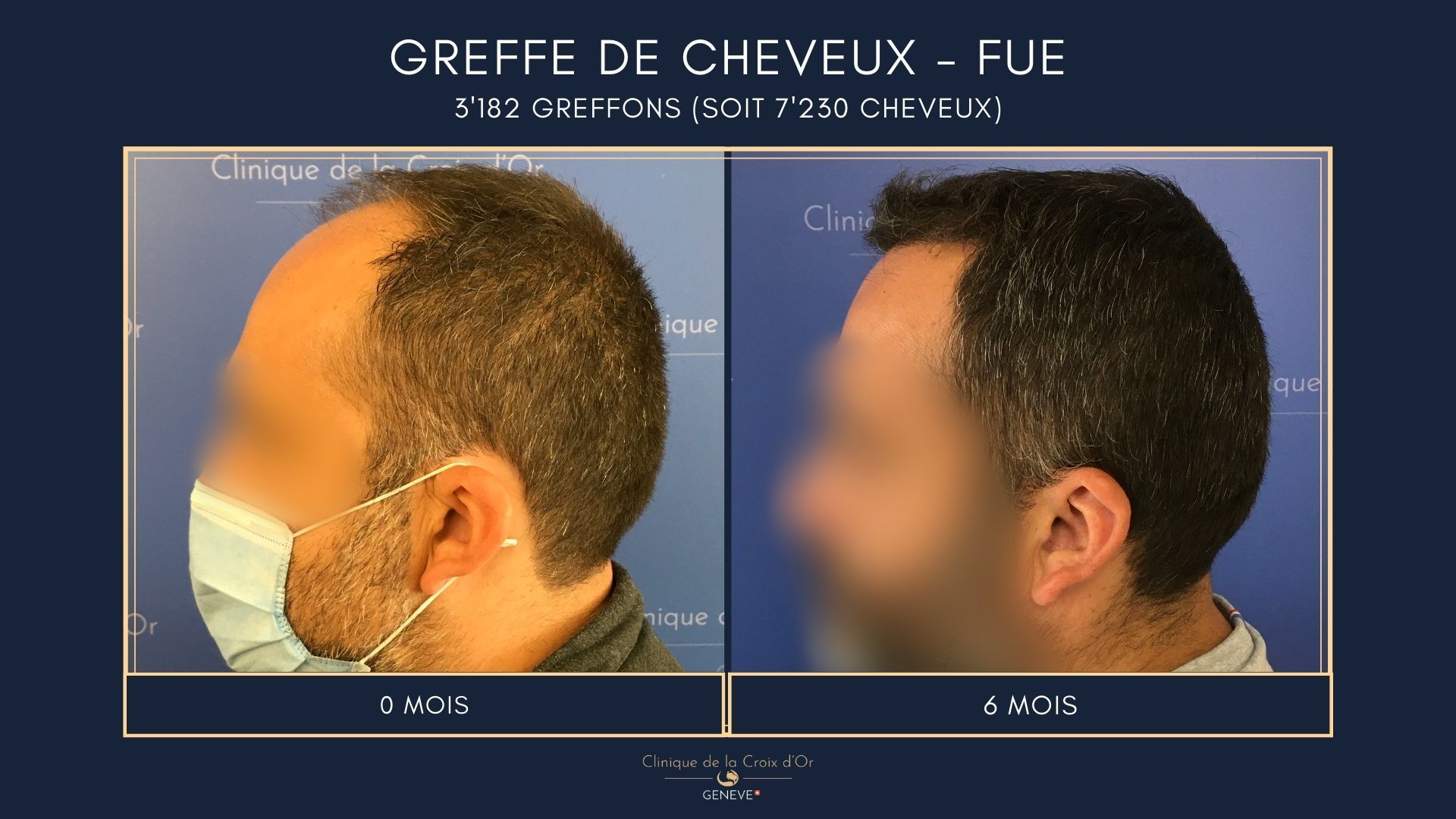 Hair Transplant - FUE
