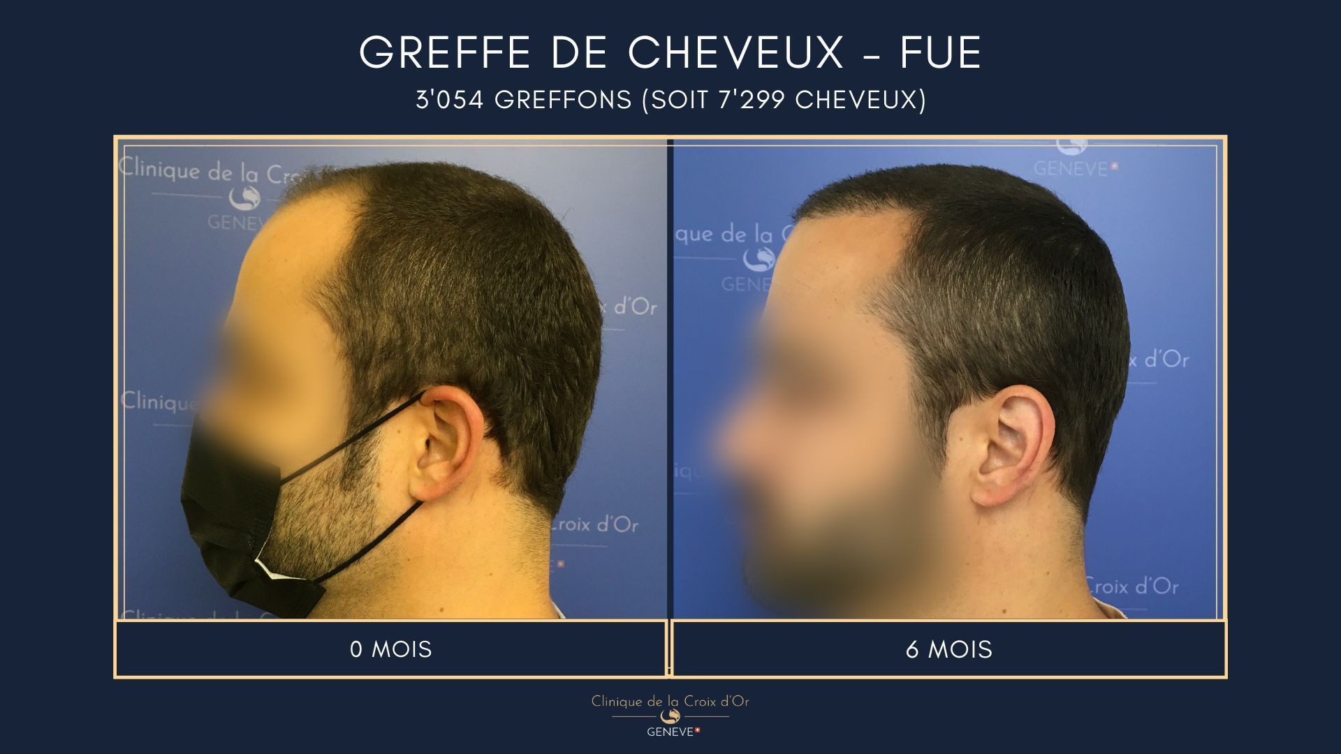 Hair Transplant - FUE