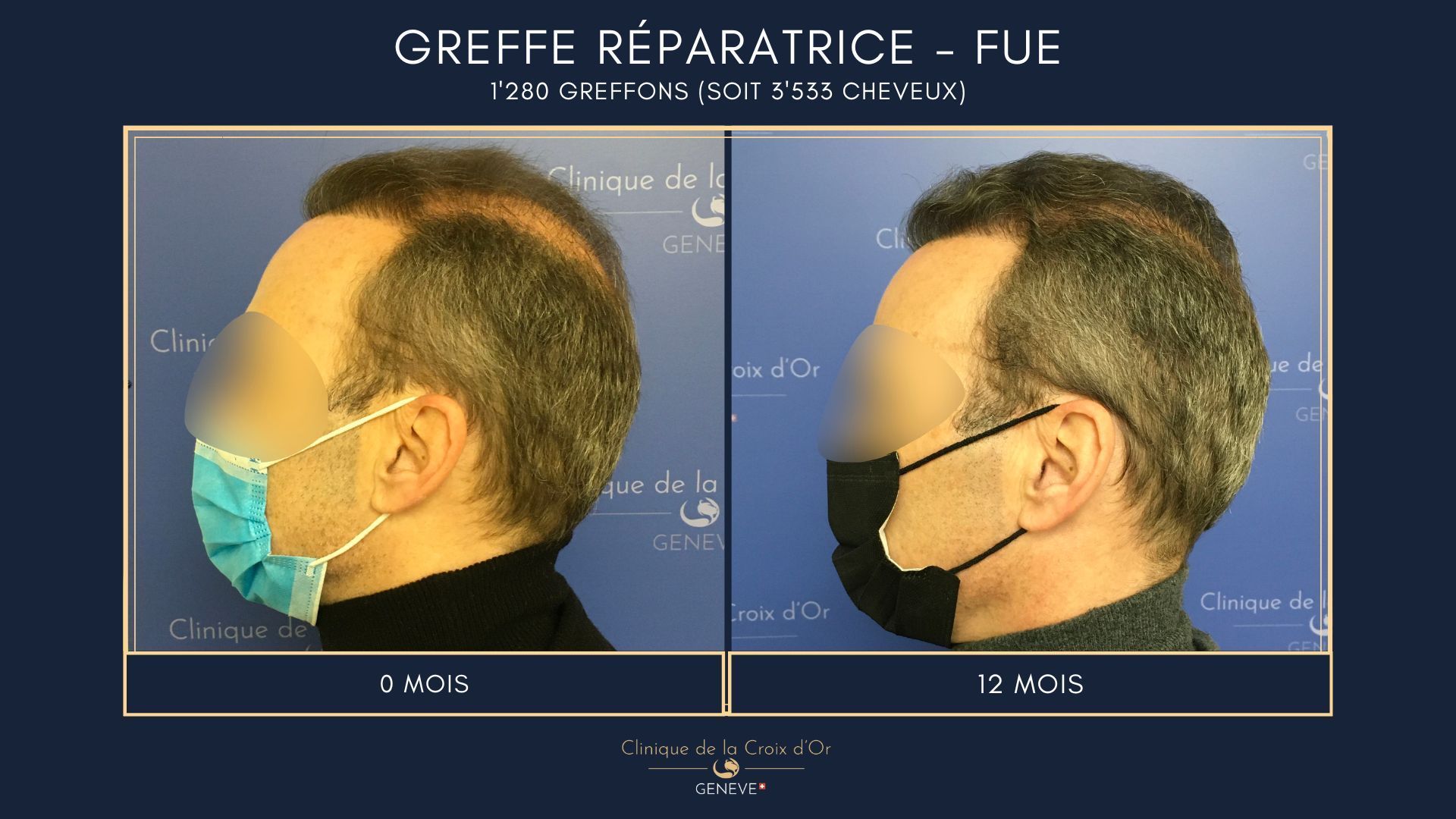 Reparative or corrective hair transplant