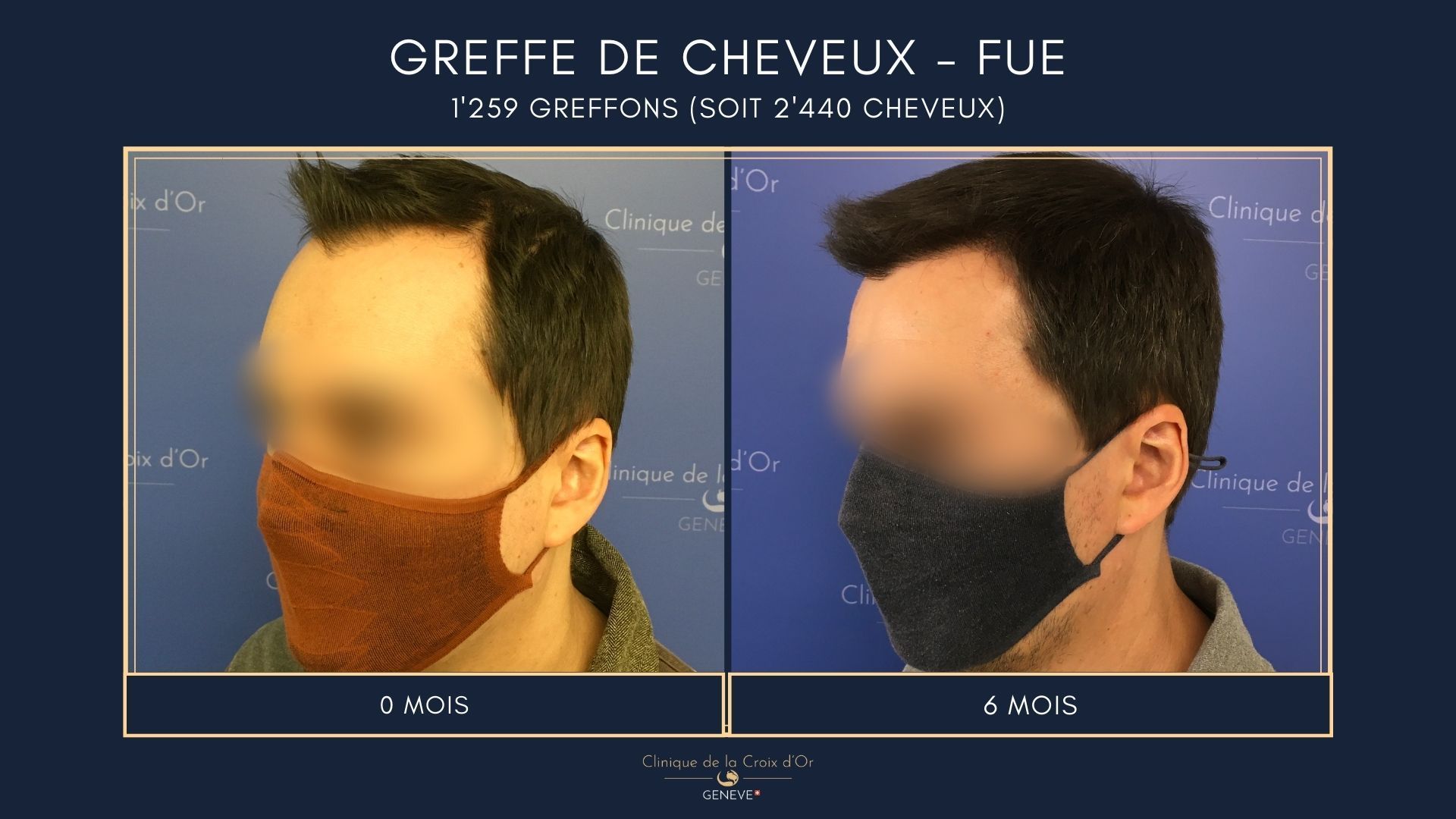 Hair Transplant - FUE