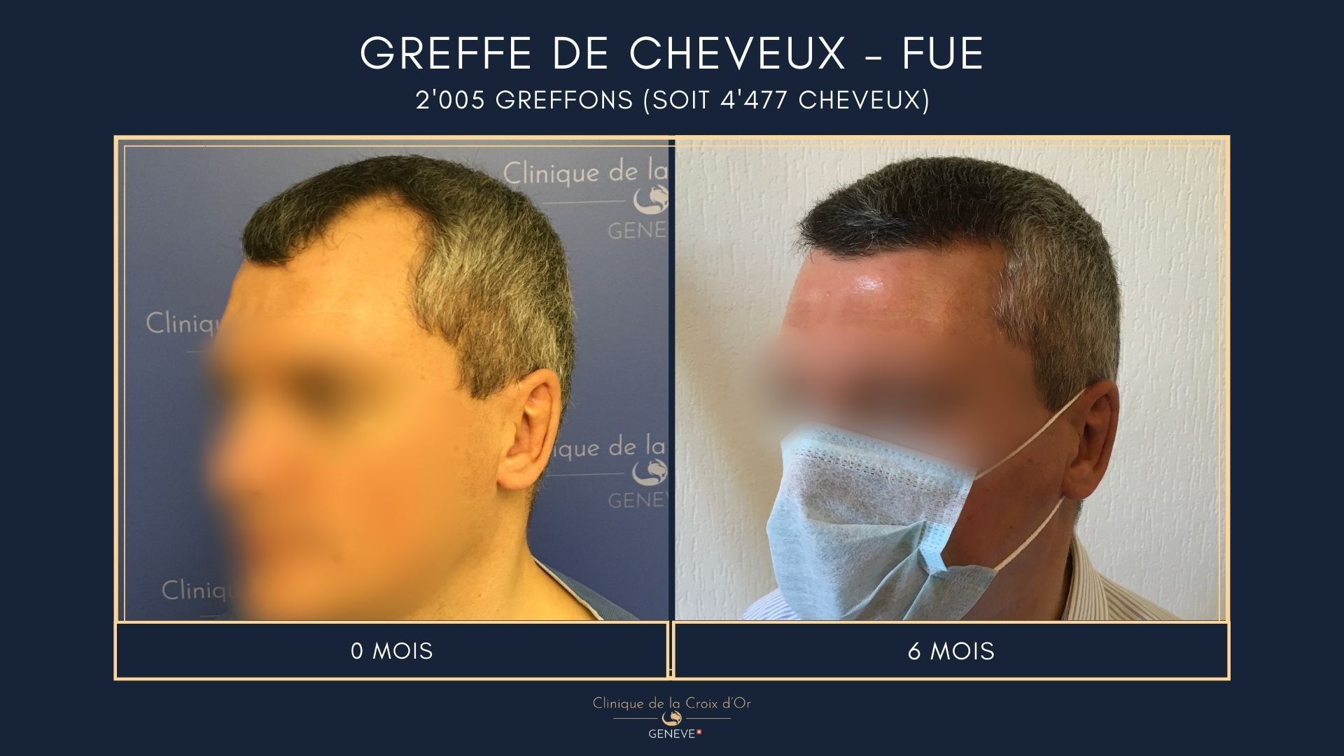 Hair Transplant - FUE