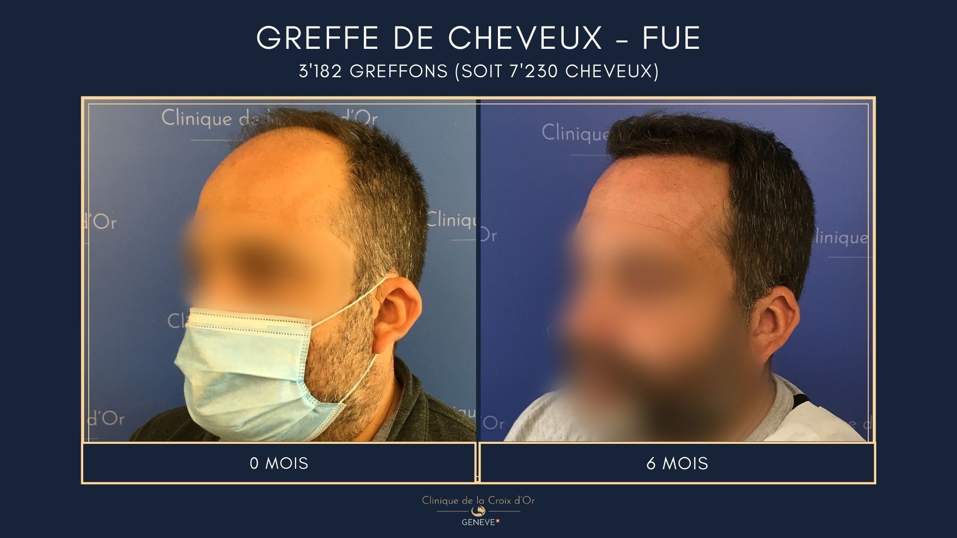 Hair Transplant - FUE
