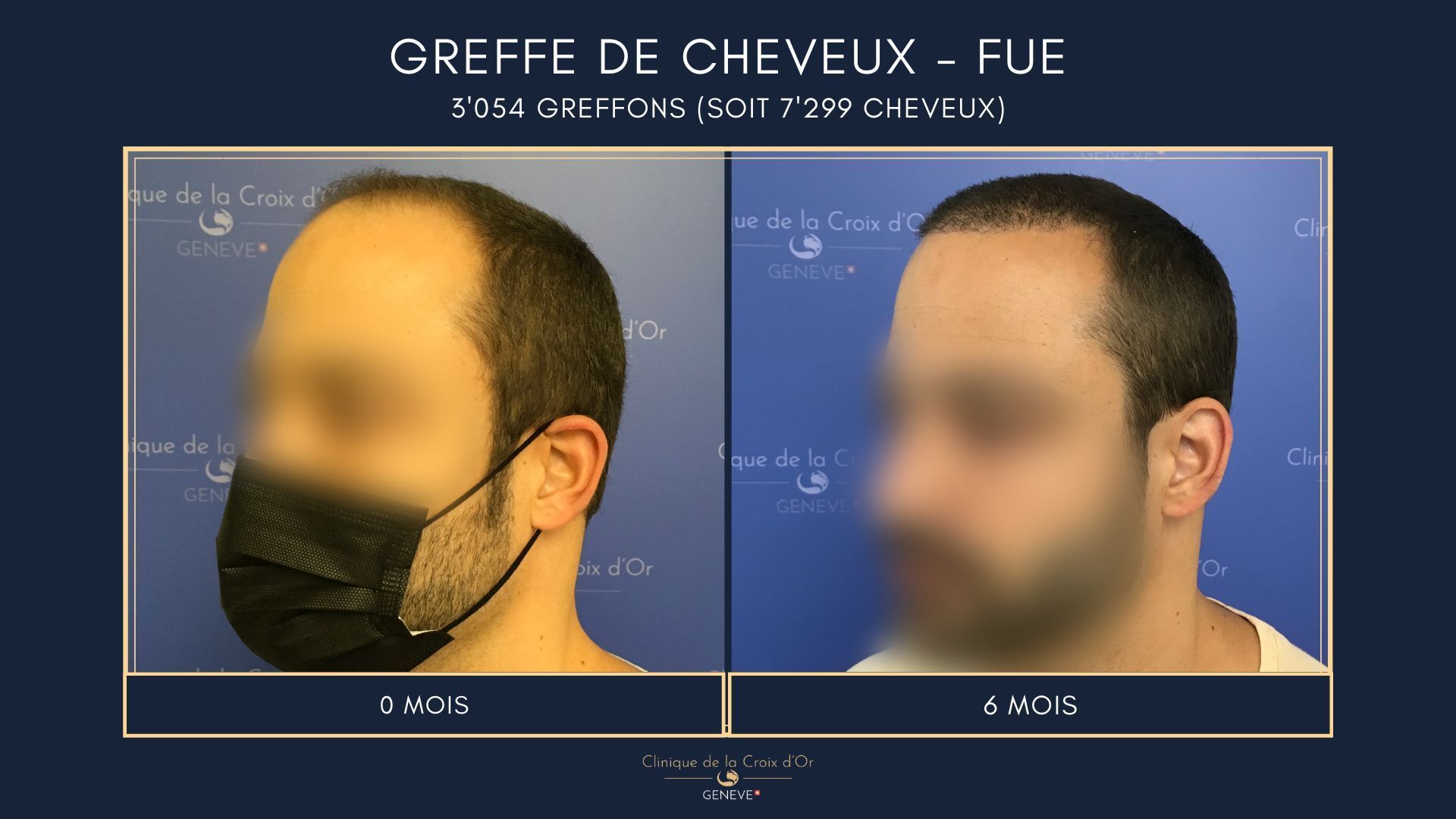 Hair Transplant - FUE