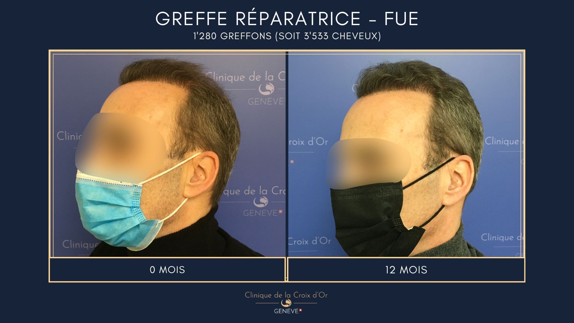 Reparative or corrective hair transplant