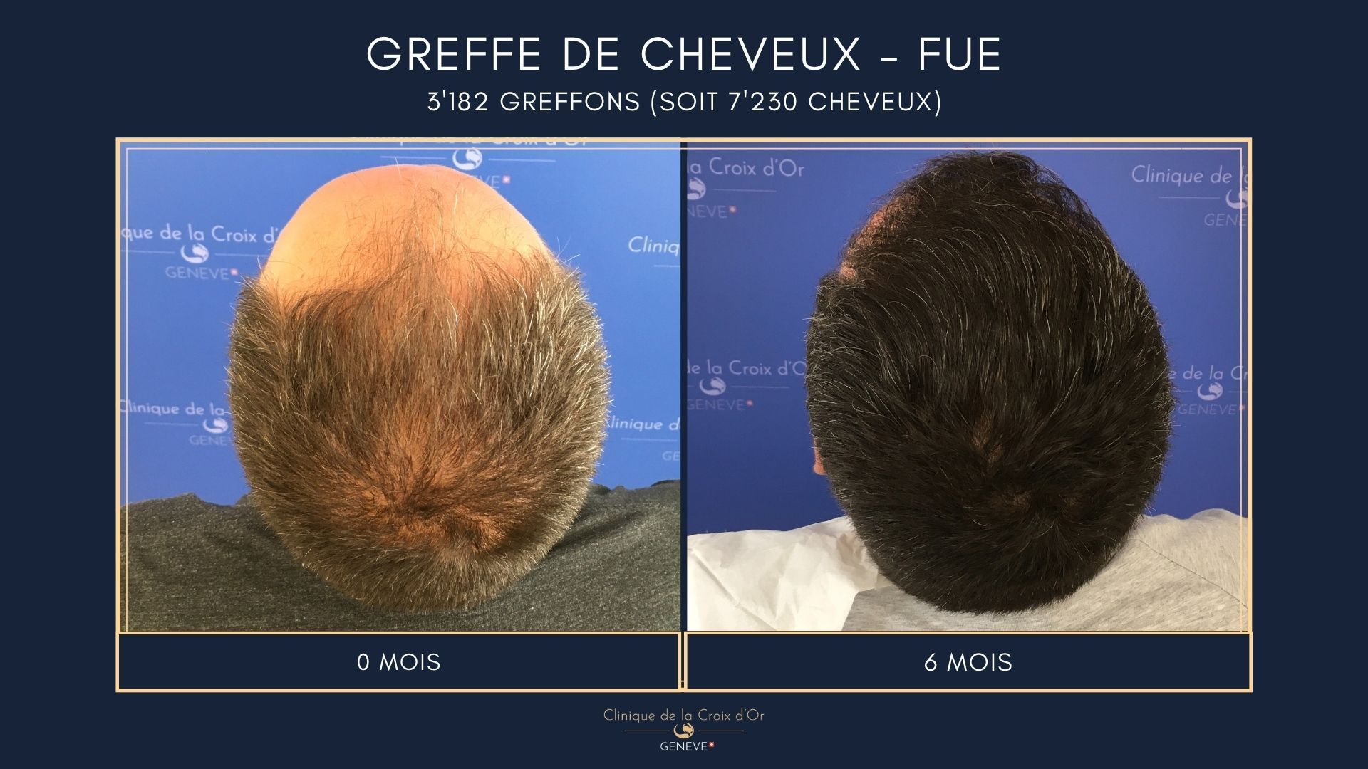 Hair Transplant - FUE