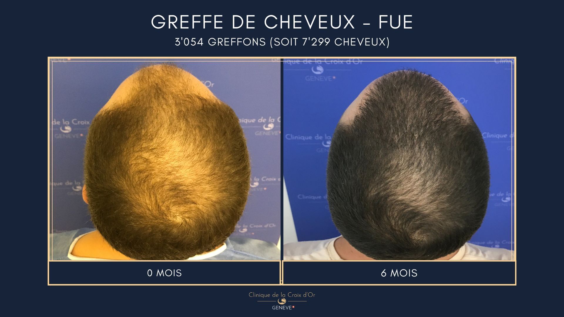 Hair Transplant - FUE