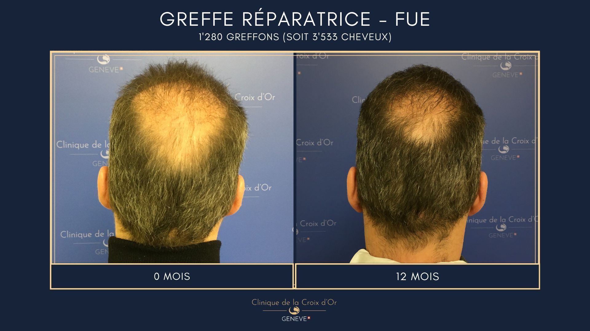Reparative or corrective hair transplant