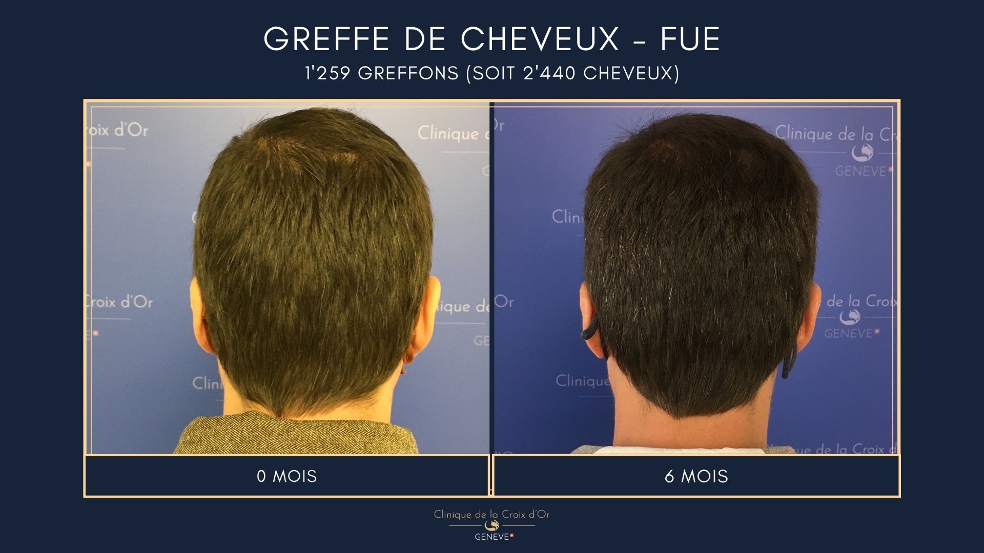 Hair Transplant - FUE