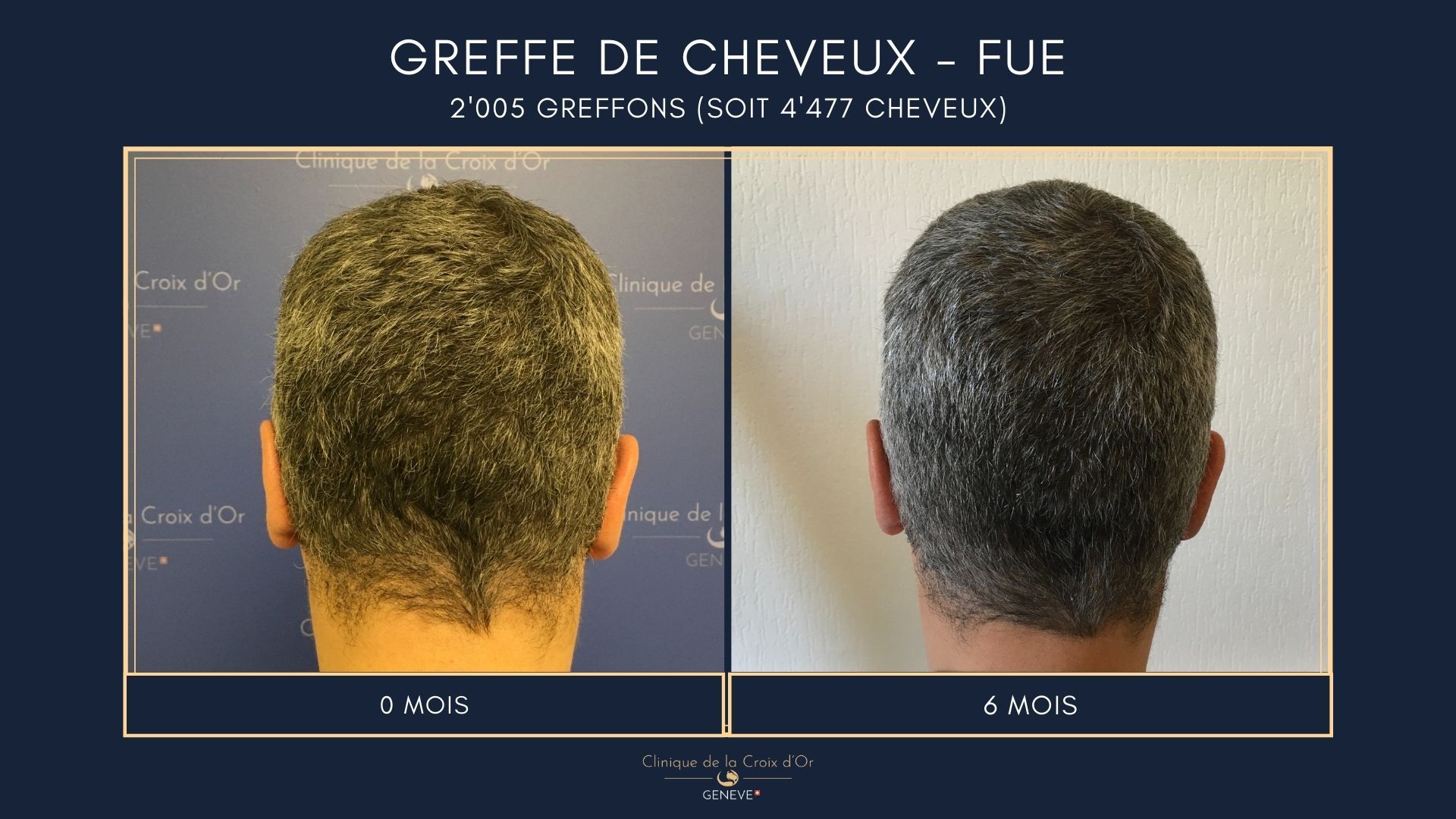 Hair Transplant - FUE