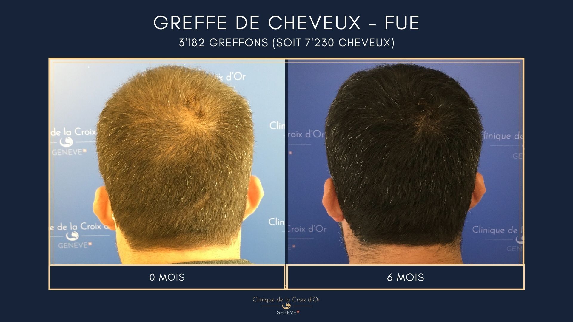 Hair Transplant - FUE