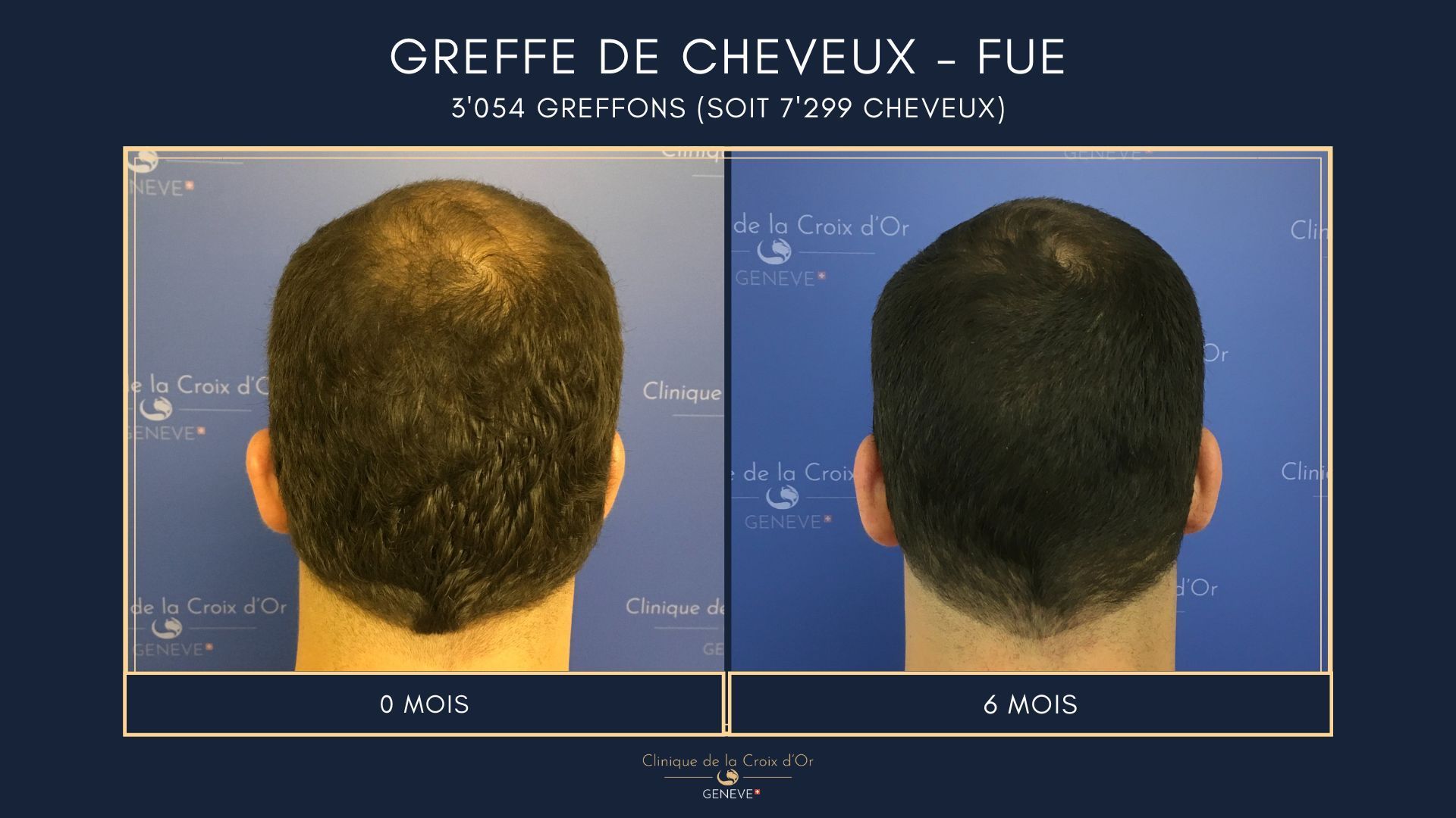 Hair Transplant - FUE