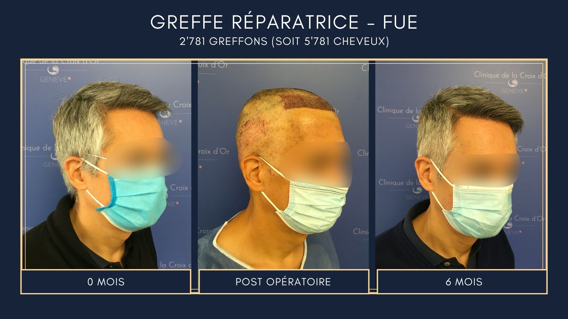 Reparative or corrective hair transplant