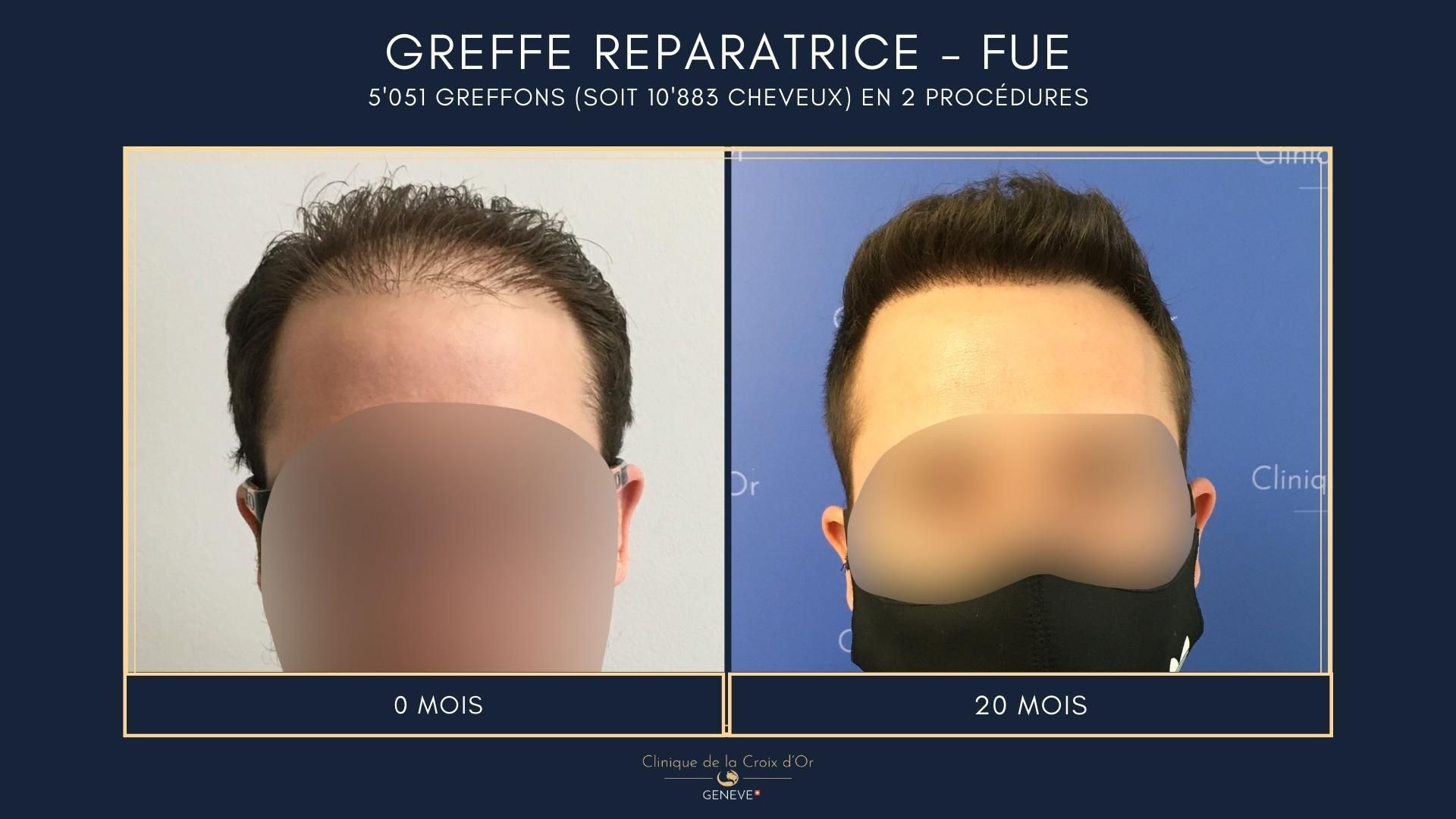Reparative or corrective hair transplant